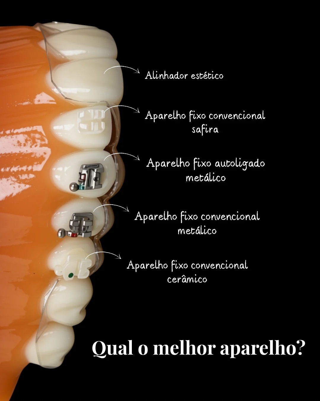Aparelho ortodôntico